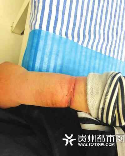 手铐 少年捡到手铐铐自己 取不下来带一年手臂已经勒变形