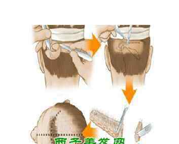 秃顶植发需要多少钱 植发有用吗 秃顶植发需要多少钱