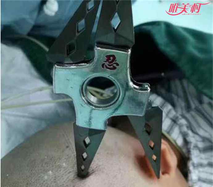 女孩被飞镖穿颅骨 女孩被飞镖穿颅骨 术后恢复良好