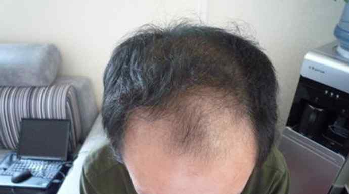 柯哲娴 18岁高中生头发掉了一半 原因就在其父亲茂密头发背后