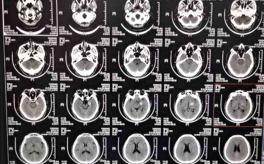 魏继光 魏继光，男性，55岁，左侧大脑后动脉动脉瘤。