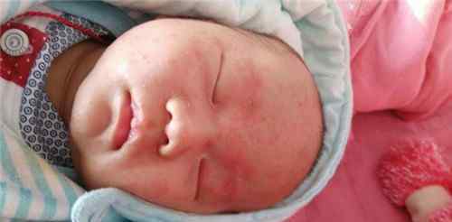 初生婴儿湿疹 刚出生的婴儿湿疹怎么办  新生儿长湿疹如何护理