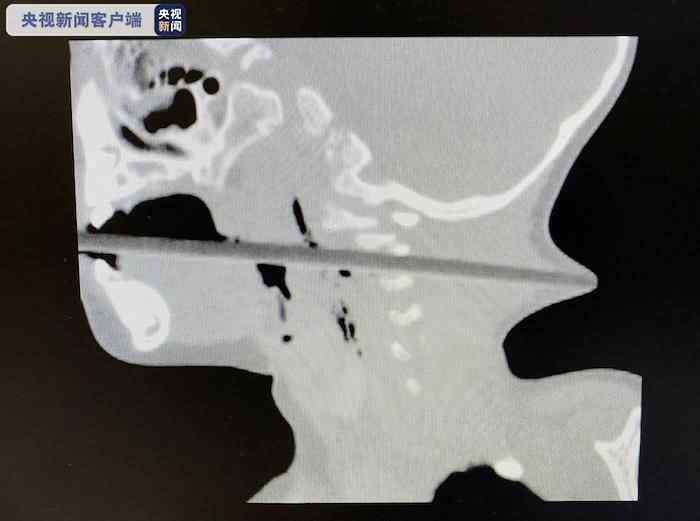 揪心！2岁幼童吃苹果被筷子贯穿喉部 从后颈戳了出来 奶奶瞬间吓傻