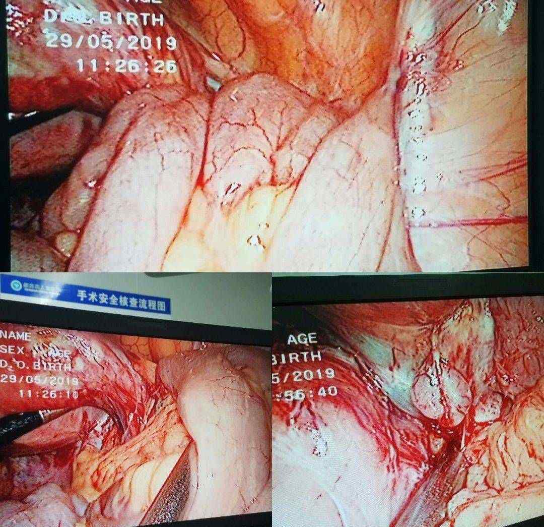 昆明妇科医院知道强生 “小眼晴，大世界” 一一我院妇科成功完成腹腔镜下盆腔重度粘连松解术！