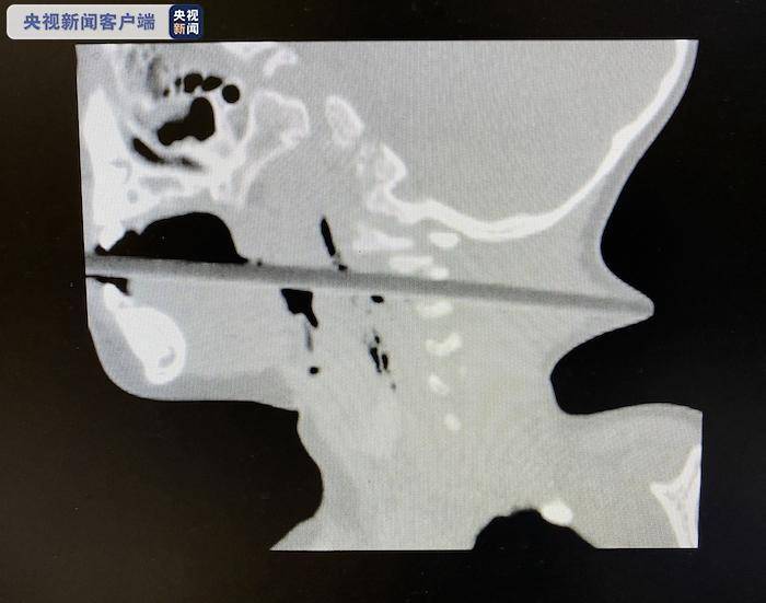 揪心！2岁幼童吃苹果被筷子贯穿喉部 从后颈戳了出来 奶奶瞬间吓傻