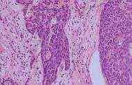 甲状腺鳞状细胞癌 甲状腺鳞状细胞癌