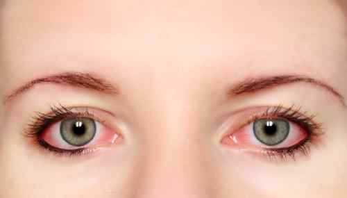 角膜炎小妙招 角膜受伤后果很严重，预防角膜炎有妙招