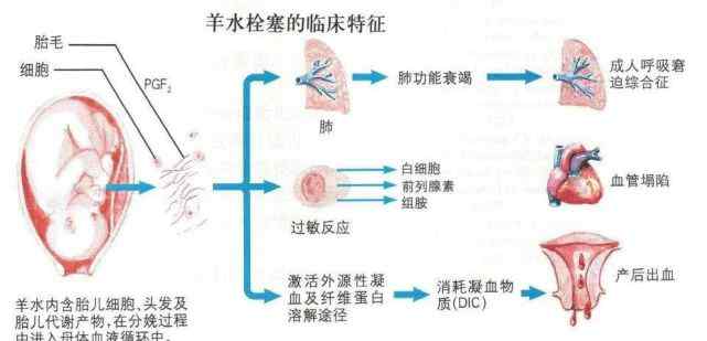 羊水栓塞死亡率 半个小时，人可能就没了！死亡率高达90％疾病，5类宝妈最易中招！