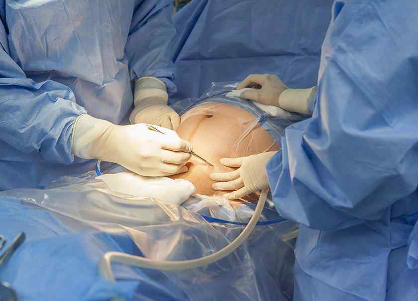 全国四次剖腹产有几例 女人可以做几次剖腹产？不是三次和五次，医生：不要超过这个数