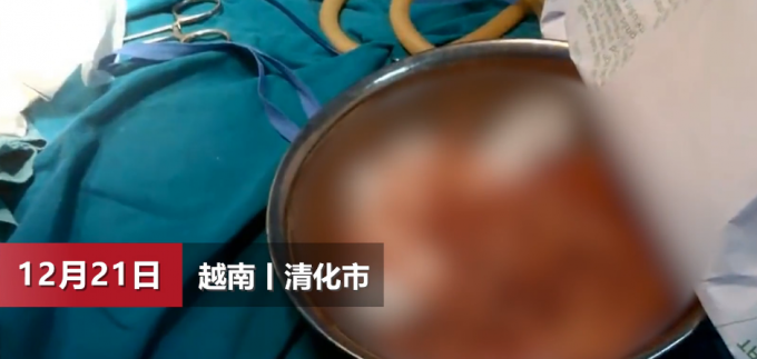 细思极恐！越南男子腹部取出上百条寄生虫 胆小的别细看