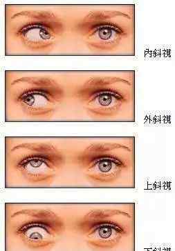 两只眼睛视力相差大怎么办 两眼近视度数差异大，是怎么回事？