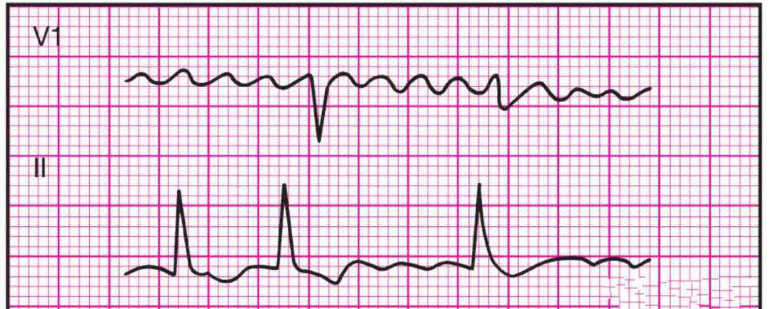 11种异常心电图 14种异常心电图的波形特点，建议收藏！