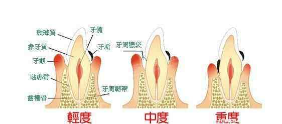 牙周炎口臭 牙疼，口臭，牙周炎，多半是它在嘴里作怪！