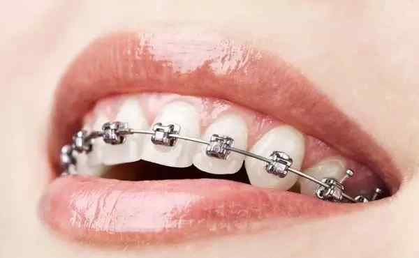 牙套什么年纪带 牙套什么年纪带比较好，牙齿矫正有哪方面的限制？