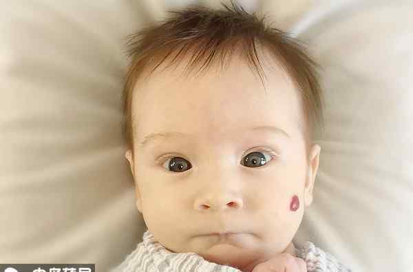婴儿皮肤下血管瘤 婴儿皮肤上长红痣，可能是“血管瘤”，别傻傻以为是胎记