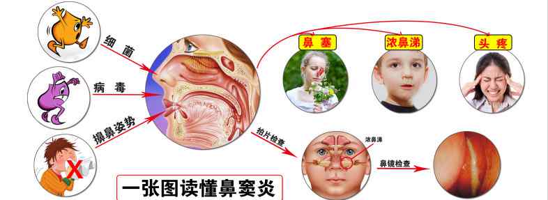 鼻炎治疗 鼻窦炎的治疗