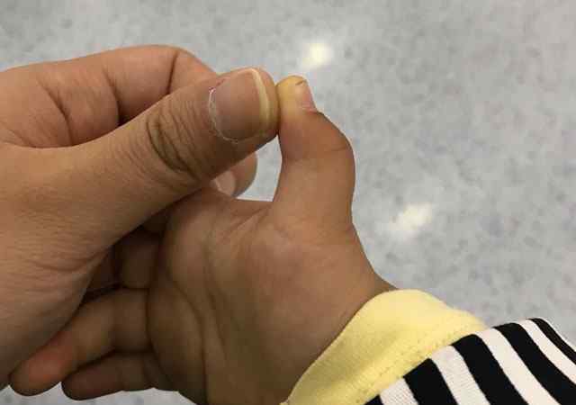 腱鞘炎的最好治疗方法 腱鞘炎怎么治疗?这才是腱鞘炎最佳治疗方法