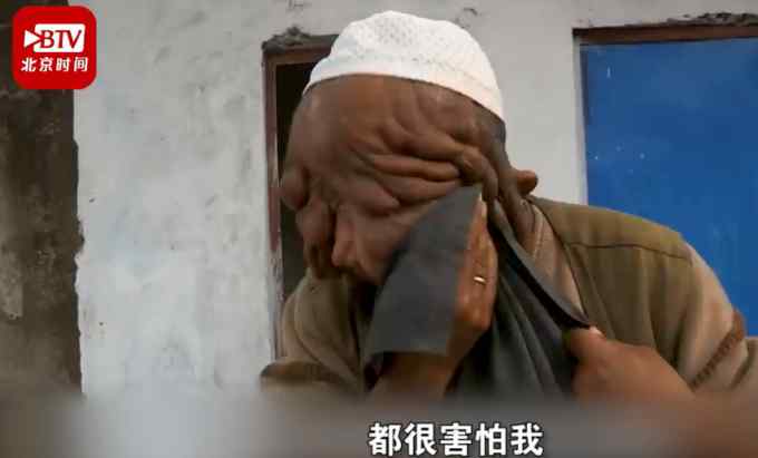 “大家都叫我无脸男”！印度一男子满脸肉瘤 曾险被当野兽枪杀