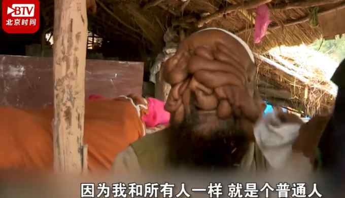“大家都叫我无脸男”！印度一男子满脸肉瘤 曾险被当野兽枪杀