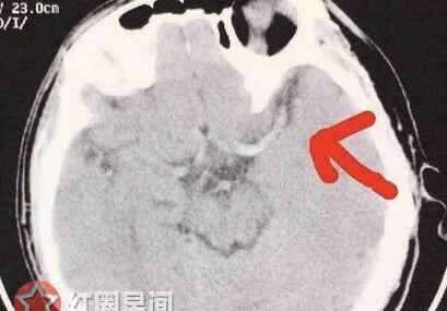 打游戏3天3夜 大学生打游戏3天3夜 放飞自我变成中风入院