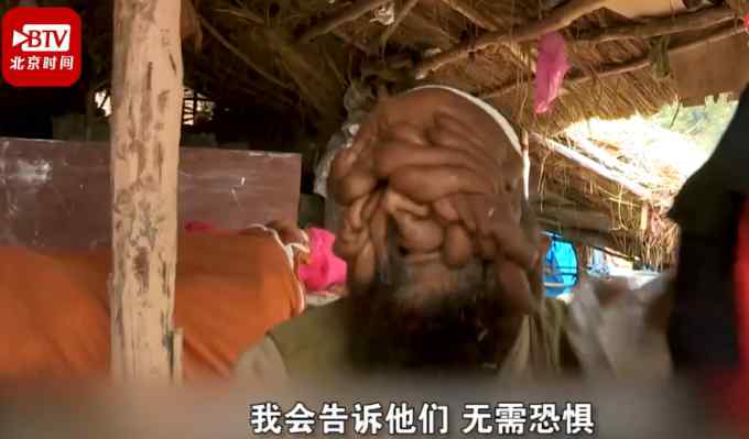 “大家都叫我无脸男”！印度一男子满脸肉瘤 曾险被当野兽枪杀