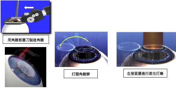 做准分子激光近视手术，你必须满足这4个条件.....