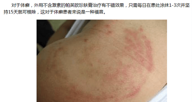 体癣初期图片症状，体癣最好的治疗方法?