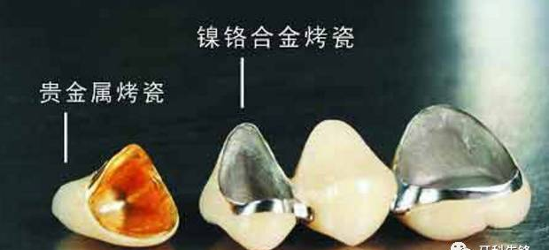 为何烤瓷牙的价格从几百元至数千元不等？