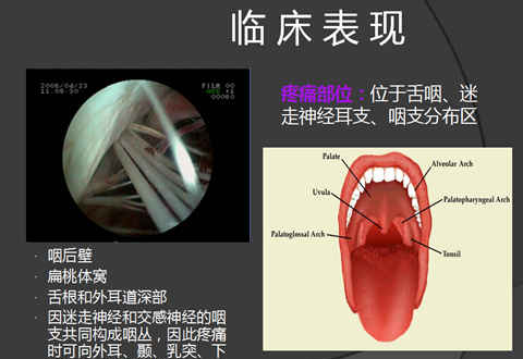 容易被误诊的“舌咽痛”，警惕舌咽神经痛