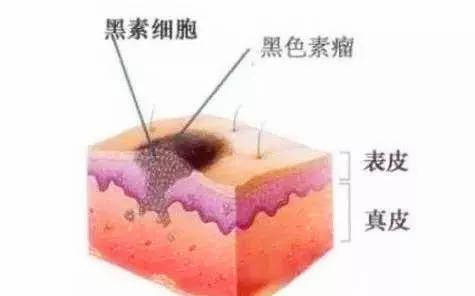 身上的黑痣出现这种情况，可能是癌变了！