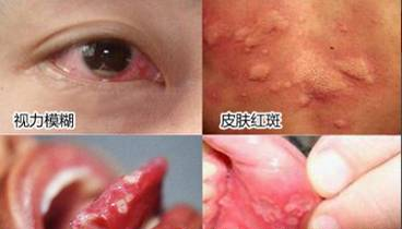白塞氏综合征
