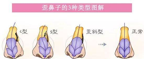 【整外干货】歪鼻的不同类型及矫正修复