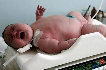世界上最重最大的婴儿，出生体重36斤，众人都吃惊不已