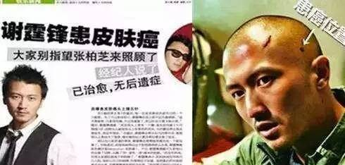 谢霆锋患皮肤癌，他说了一句话，让人警醒又感慨万千！