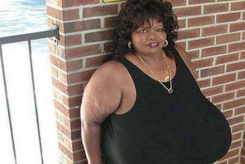 世界上最大的天然乳房，安妮·霍金斯·特纳双乳重达35.8公斤