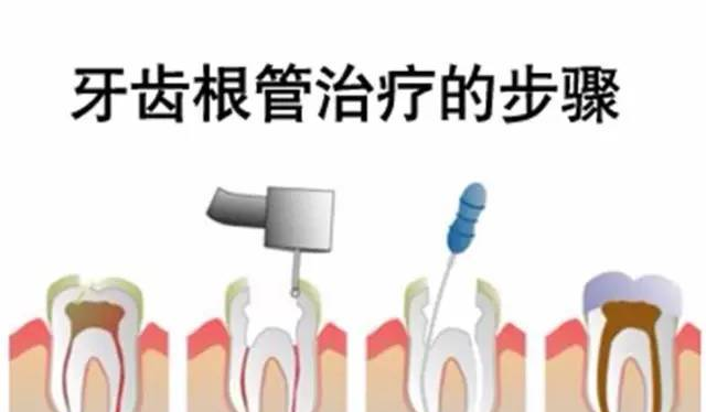 根管治疗全过程，看完你就明白了