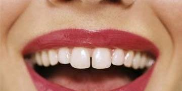 5个方法解决牙齿缝隙大