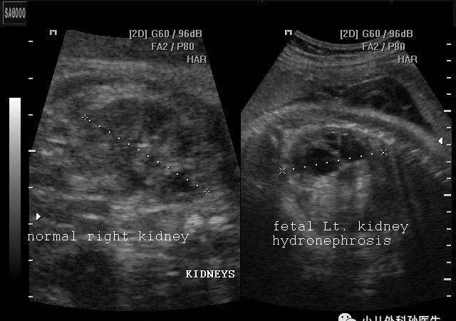 谈谈胎儿和小儿肾积水，不紧张，也别大意