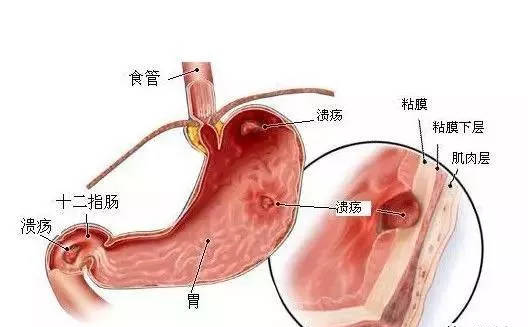 糜烂性胃炎，还能活多久？你不是开玩笑吧？没事的
