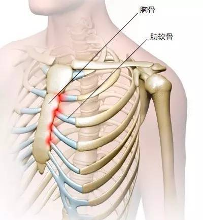 肋软骨炎是怎么回事？