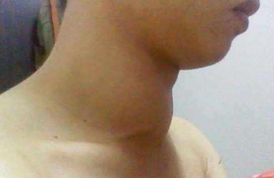 患上喉癌后，这5个身体征兆很常见，有2个以上要去检查了