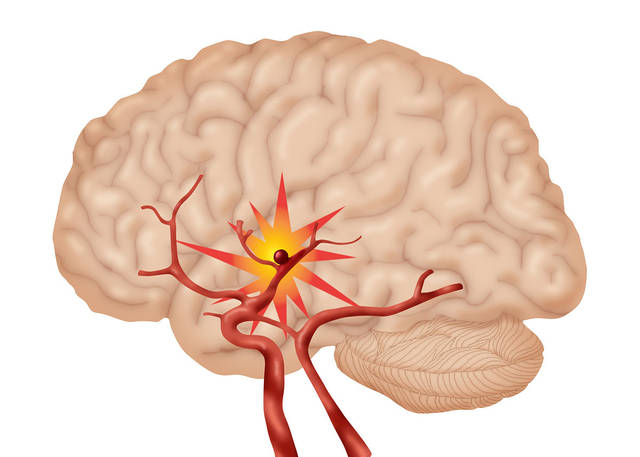 脑血管硬化早期会有这四种表现，医生说这三类人一定要重视！