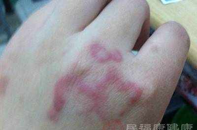 麻风病的早期症状是什么 有这些症状要小心