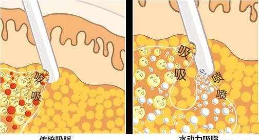 Body-jet水动力吸脂丨科普篇