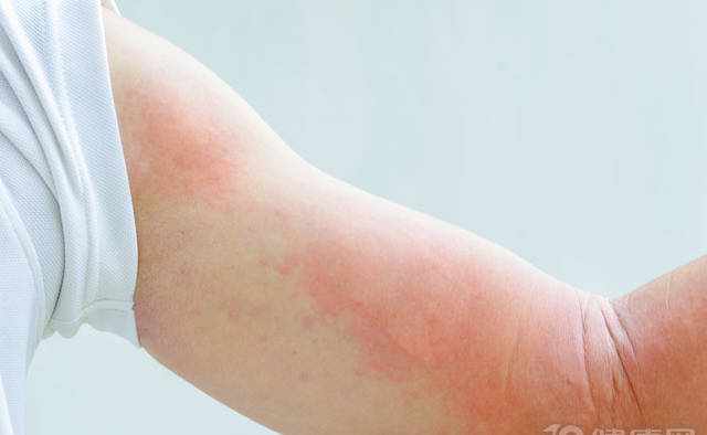 为什么好好的皮肤会长荨麻疹？这6个因素是“原罪”！