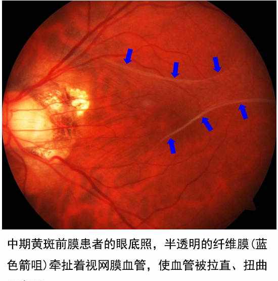 选对治疗方法，黄斑前膜并不可怕！