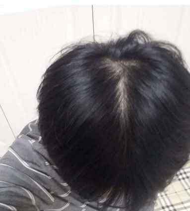 为什么会秃顶 为什么有些人会秃顶一秃就秃成地中海？看完后觉得我也要秃了！