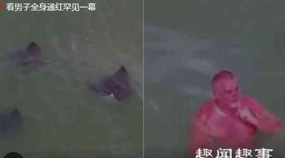 巨型黄貂鱼 男子在海中游泳全身通红如同被“煮熟” 网友看完直呼奇葩