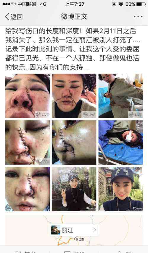 丽江毁容 丽江恶性毁容抢劫案女孩琳哒是我资料照片 讲述事情经过