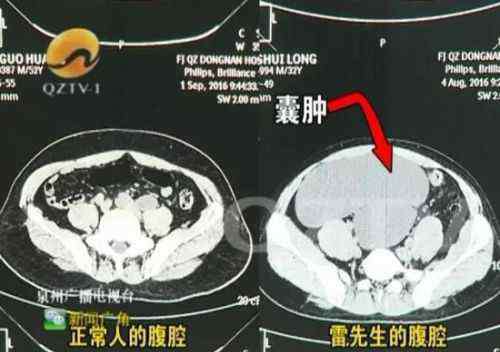 男人怀孕肚子越来越大 福建一男子腹部隆起似“怀孕” 原来体内长有4个肾